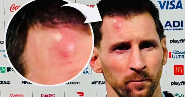 Messi sưng vêu trán sau trận thắng Cabo Verde: Vì sao nên nỗi? - hình ảnh - shbetvn1.com Messi sưng vêu trán sau trận thắng Cabo Verde: Vì sao nên nỗi? - hình ảnh - shbetvn1.com